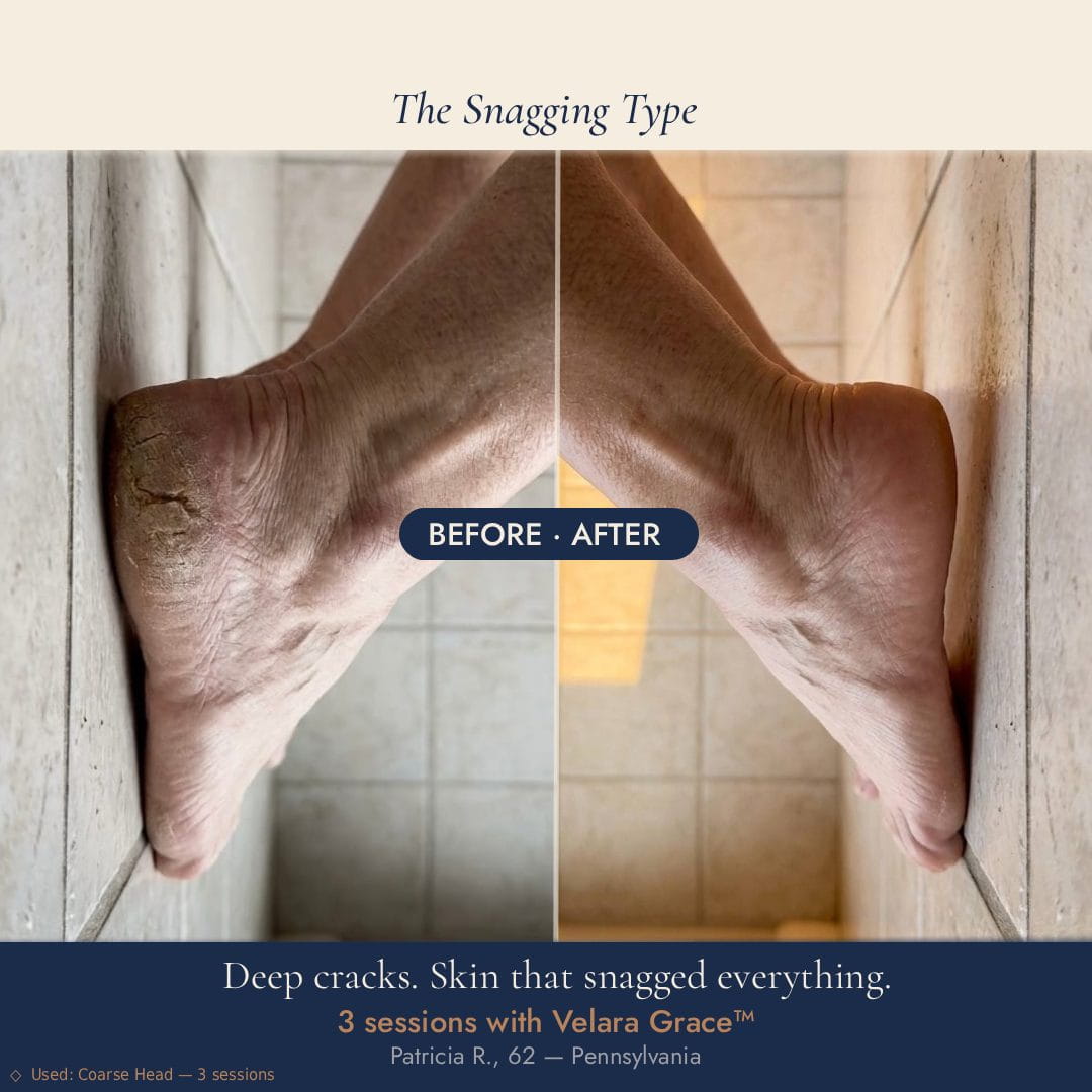 Before and after results showing severe dry cracked heels 
transformed after 3 sessions with Velara Grace electric foot file — 
Patricia R., 62, Pennsylvania.
