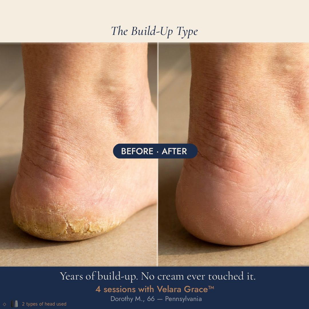 Before and after thick yellowed heel callus build-up 
treated in 4 sessions with Velara Grace electric foot file — 
Dorothy M., 66, Pennsylvania.